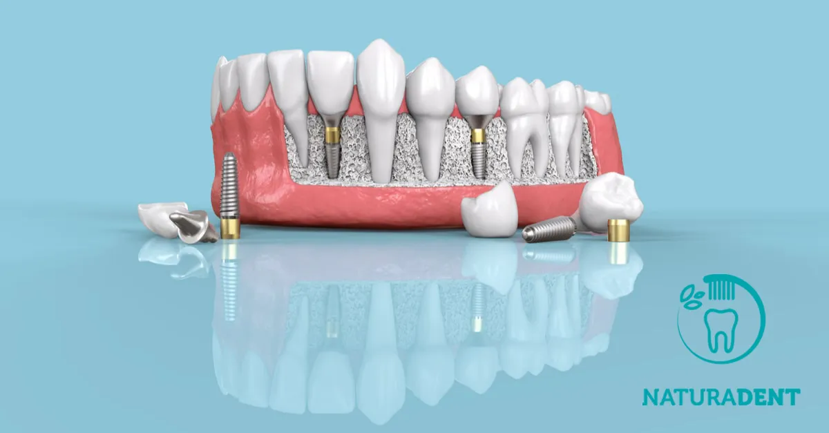 Todo sobre cómo se realiza un implante dental